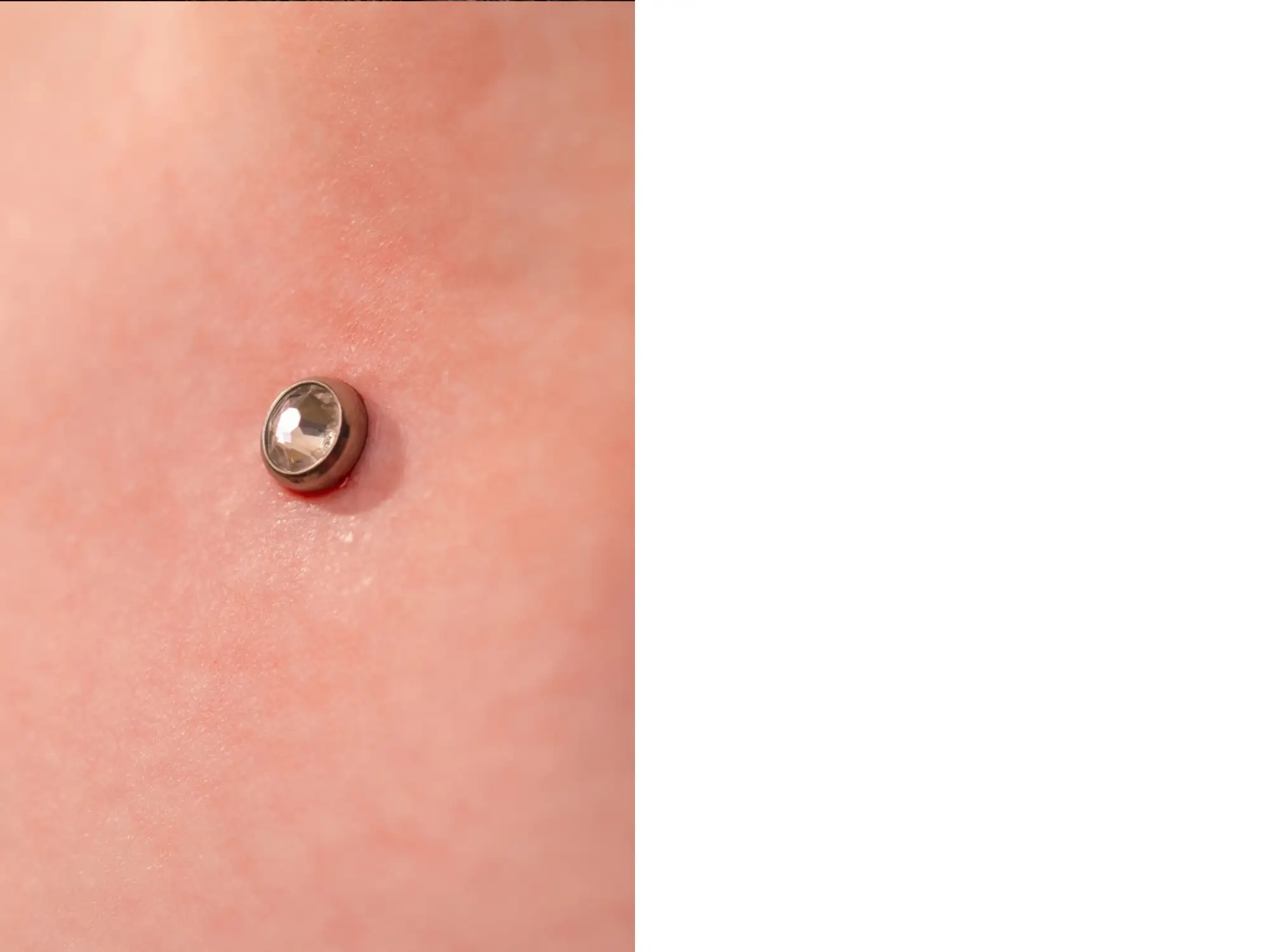 Microdermal sur la peau